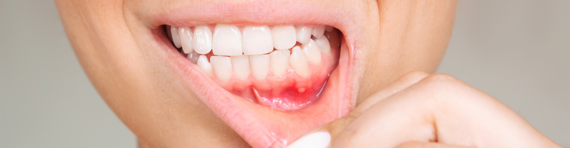 Woman pulling down lower lip to reveal inflamed gums.